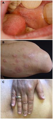 Lichen planus pemphigoides with predominant mucous membrane involvement: a series of 12 patients and a literature review